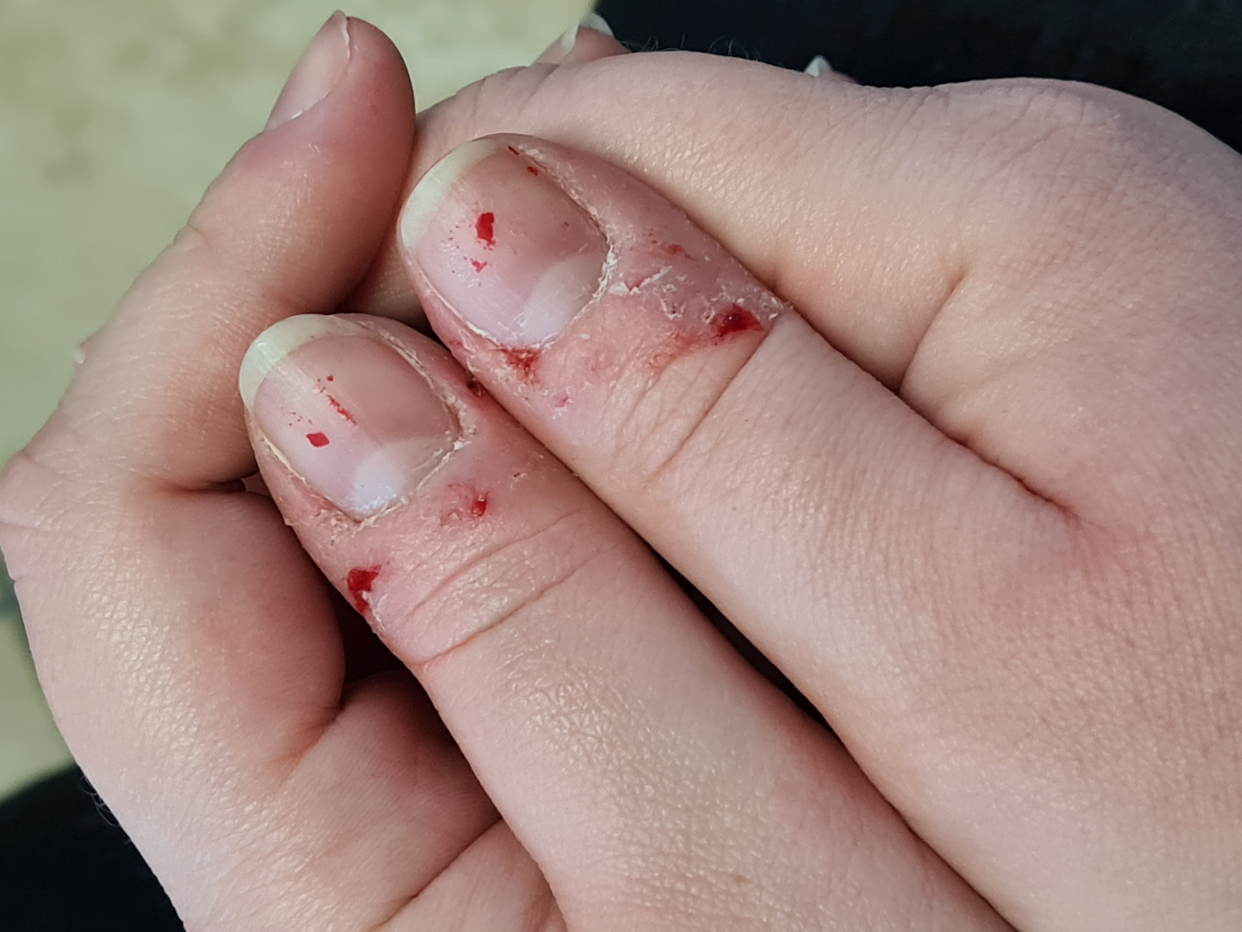 手指的皮肤被撕破并流血的图片，这是由于皮肤躁狂——焦虑的表现。