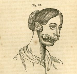 这幅画描绘了一位患有颌骨坏死(俗称“磷性颌骨”)的妇女。